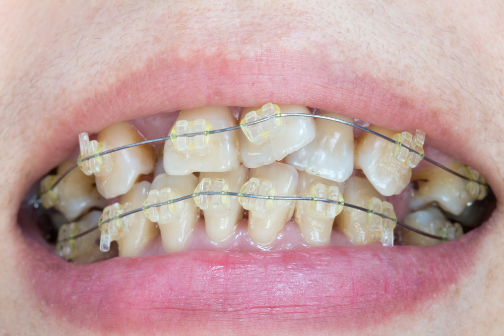 6 Benefits of Having Straight Teeth Call Your Local Orthodontist